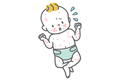 アトピー性皮膚炎